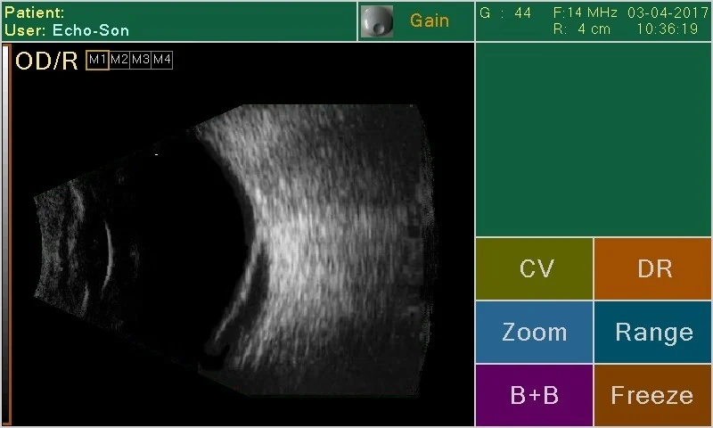 Écran officiel d’imagerie B-Scan PIROP