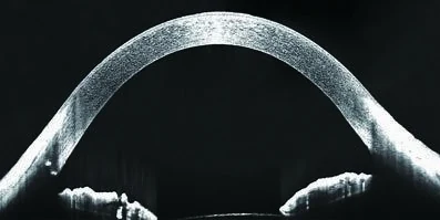 Official HOCT-1F anterior-segment section