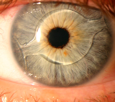 Lentilles Intraoculaires (IOL) Avancées